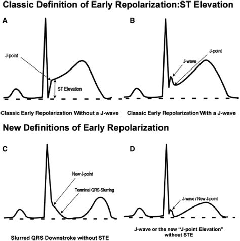 early repolarization in young males.